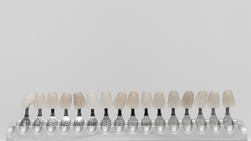 Porcelain Fused to Metal Crown